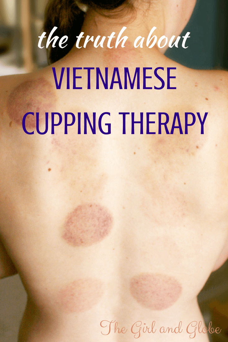This travel writer got a Vietnamese massage, including suction cup therapy. Find out what it's like and whether or not it's painful (yes, it can leave bruises or hickeys).